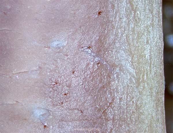 Small intramural coronaries with CAV